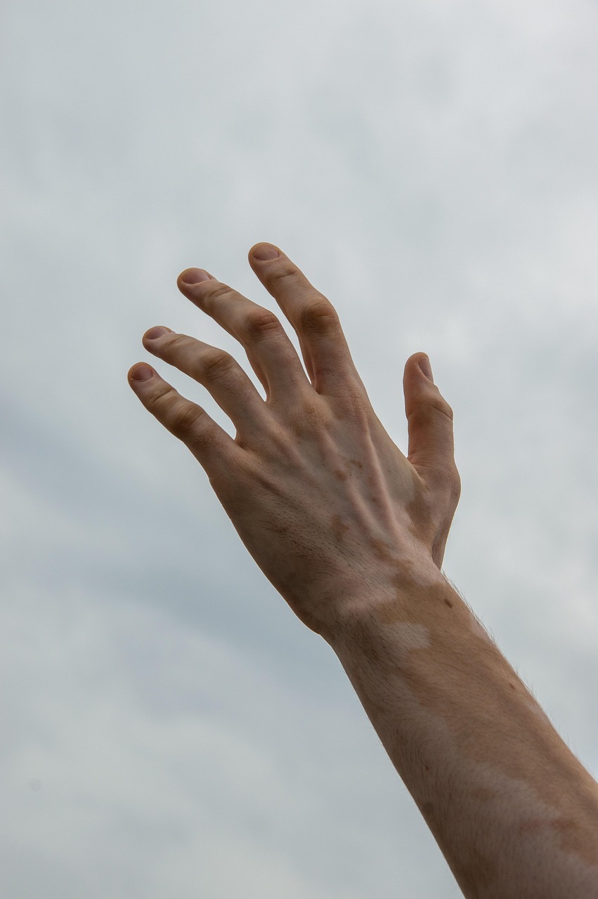 hand, skin, fingers, melanin, vitiligo, pigment, sky, vitiligo, vitiligo, vitiligo, vitiligo, vitiligo